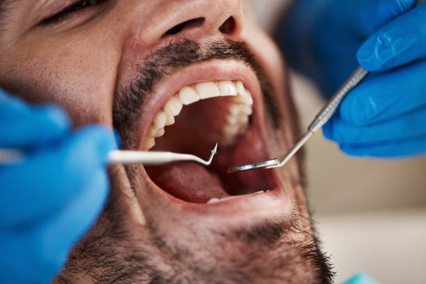 Best Knocked-Out Tooth (Avulsed Tooth) Treatment in Indio, CA